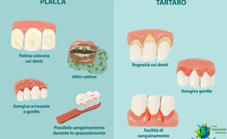 Placca e tartaro, quali sono le differenze e cosa fare