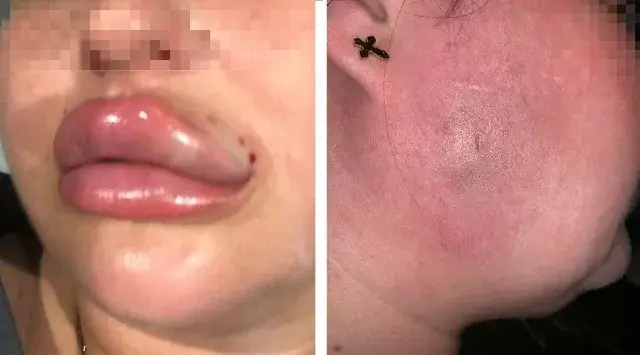 Co na opuchliznę ust po kwasie hialuronowym? Skuteczne metody łagodzenia bólu