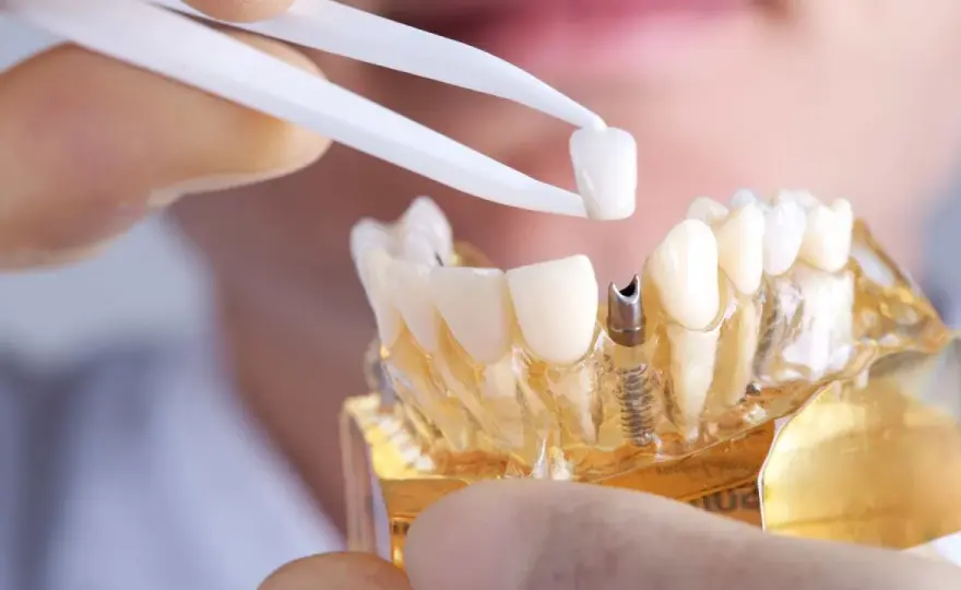 Denti in Zirconio - Pro e Contro: La Guida Definitiva