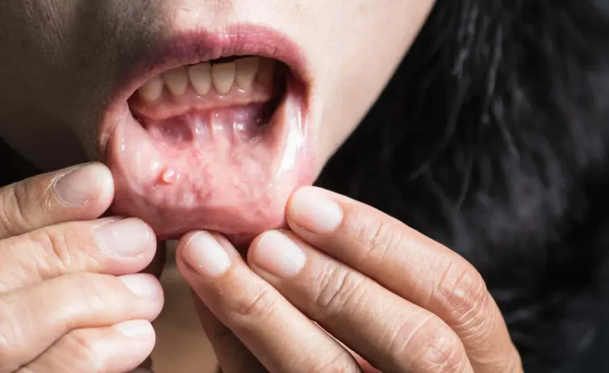 Mucocele oral, cuándo vigilarlo y cómo se trata