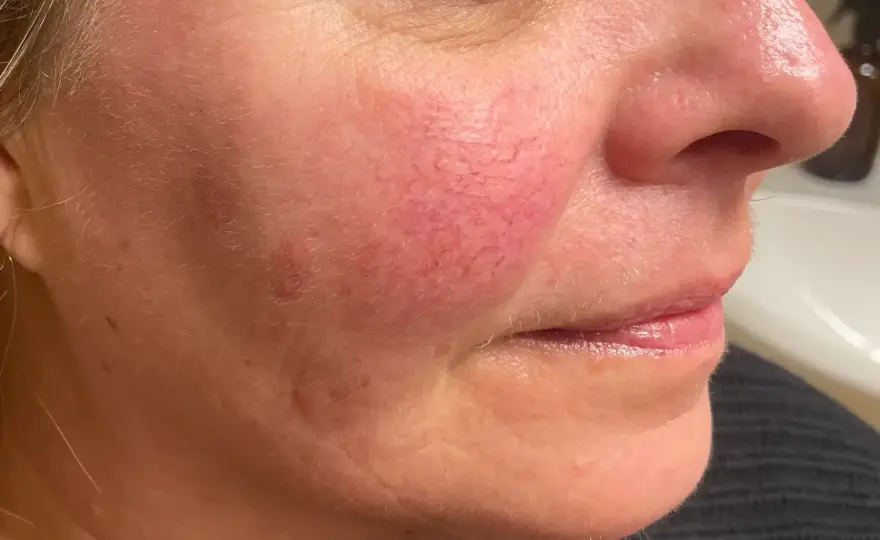 Reaktiv hud - Lugna rodnad och irritation effektivt