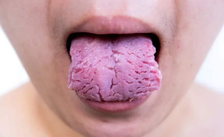 Herida en la lengua - qué hacer y cuándo acudir al dentista