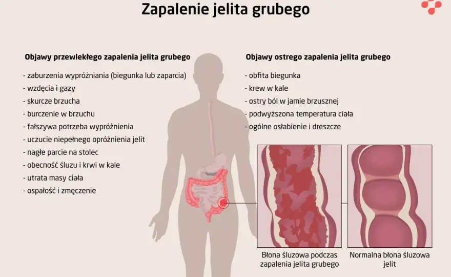 Bakteryjne zapalenie jelit: Objawy, których nie wolno lekceważyć