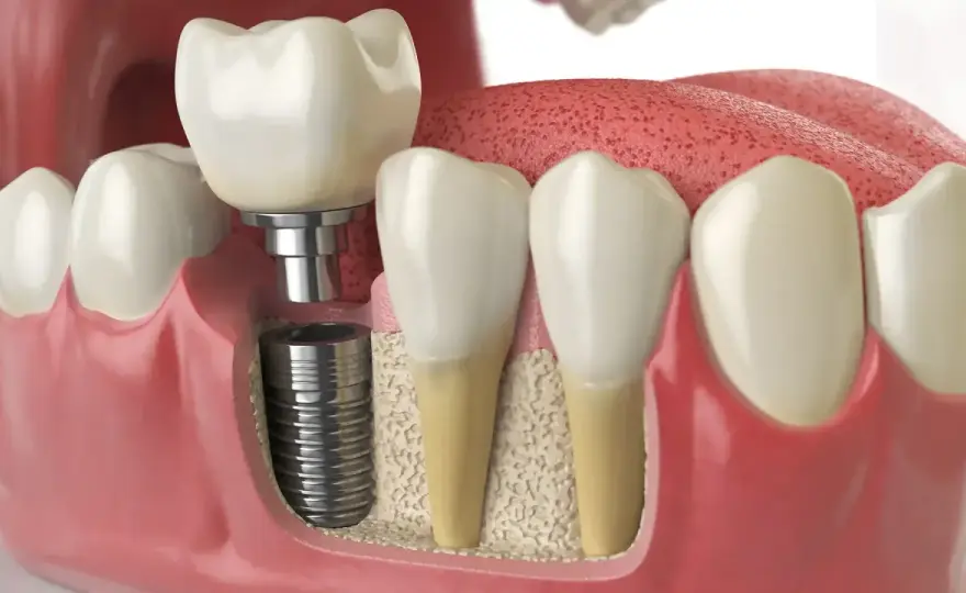 Innesto osseo dentale - Gonfiore, dolore: cosa è normale?