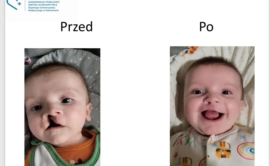 Rozszczep wargi górnej - Prawda o leczeniu i wsparciu