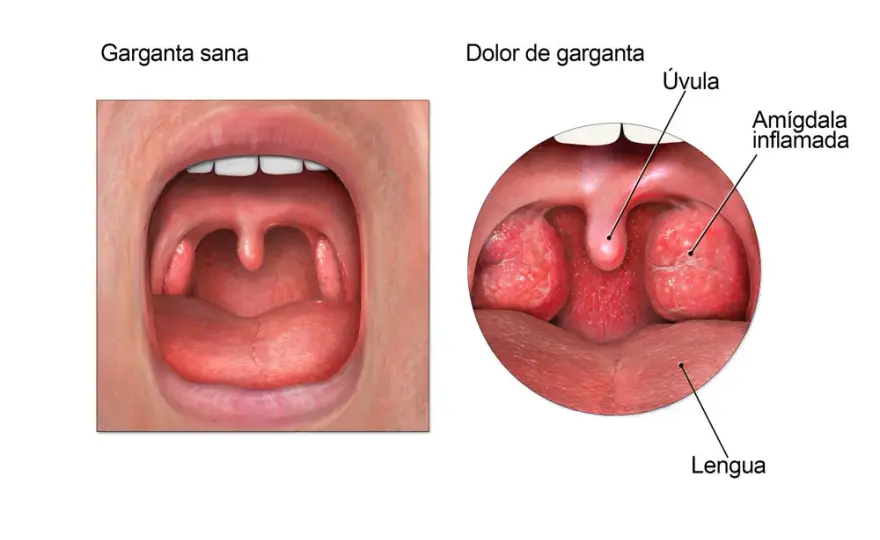 Medicamentos para el dolor de garganta: alivia el malestar rápidamente