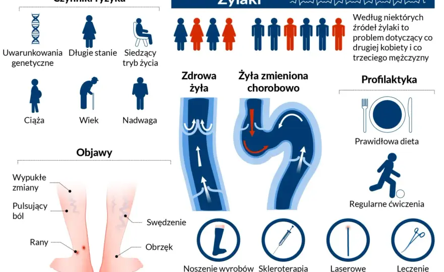Żylaki - tylko estetyka czy choroba? Objawy, leczenie, alarmy