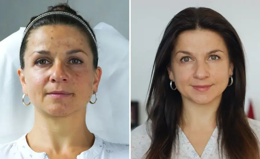 Fibryna bogatopłytkowa - kiedy naprawdę ma sens?