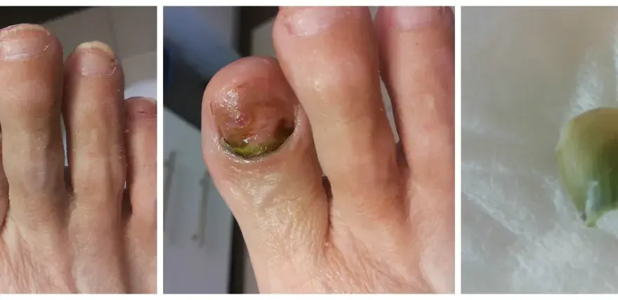 Zielony paznokieć - Czy zniknie sam? Prawda o Pseudomonas!