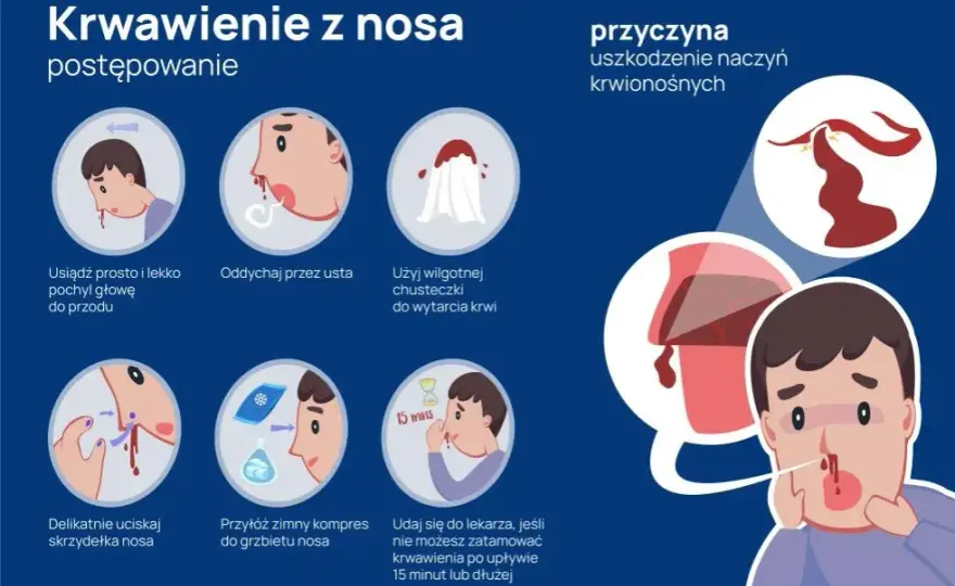 Krwawienie z nosa przyczyny: najczęstsze powody i co z nimi zrobić.