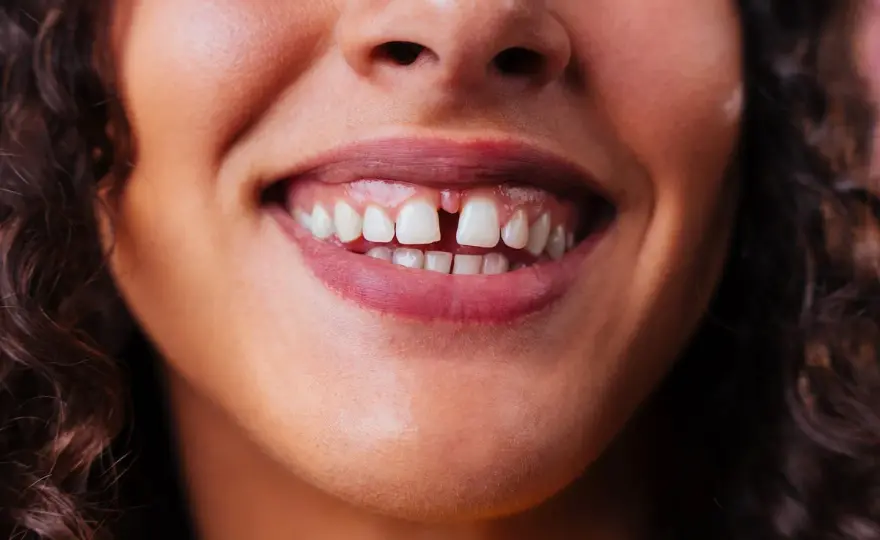 Diastema - Przerwa między zębami: Kiedy leczyć, kiedy obserwować?