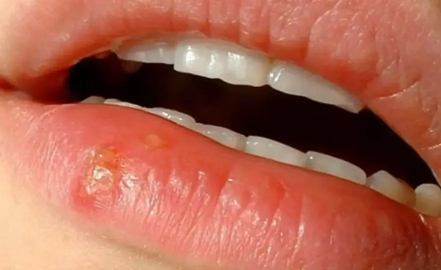 ¿Cuánto dura un herpes labial y cuándo deja de contagiar?