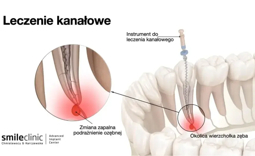 Leczenie kanałowe: Objawy, przyczyny i kiedy jest konieczne?
