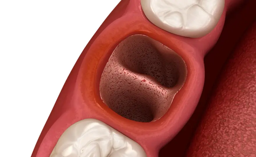 Dziura po ósemce - Gojenie, suchy zębodół i kiedy do dentysty?