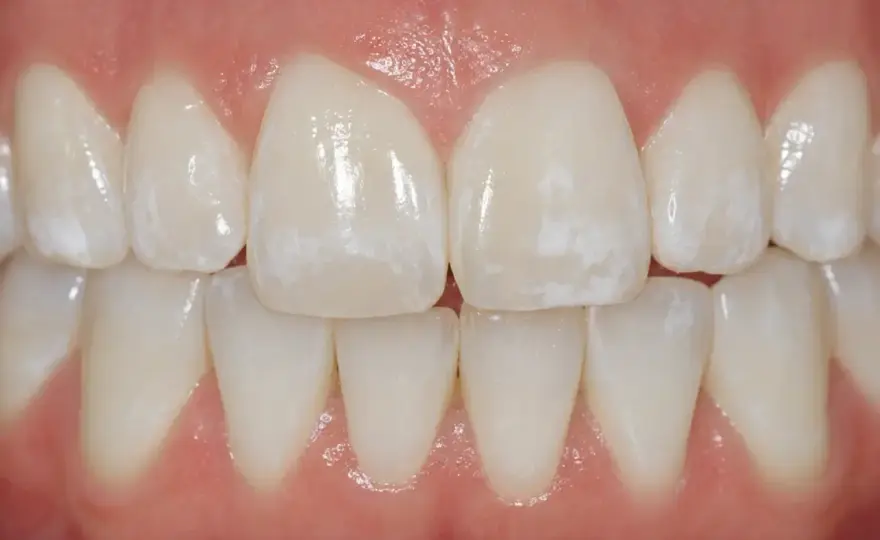 Macchie bianche sui denti? Cause, cure e quando andare dal dentista