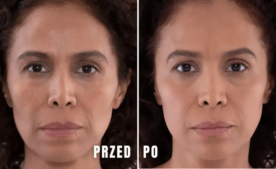 Kwas polimlekowy pod oczy - Zanim zdecydujesz