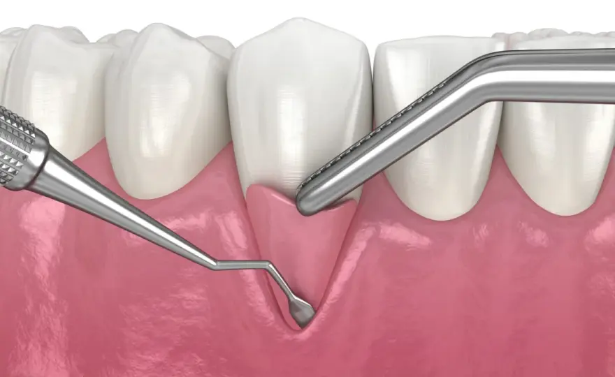 ¿Las encías se regeneran? Qué ocurre en cada caso