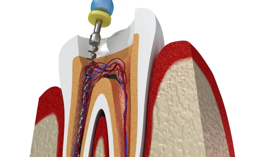¿Se puede salvar un diente con caries avanzada?