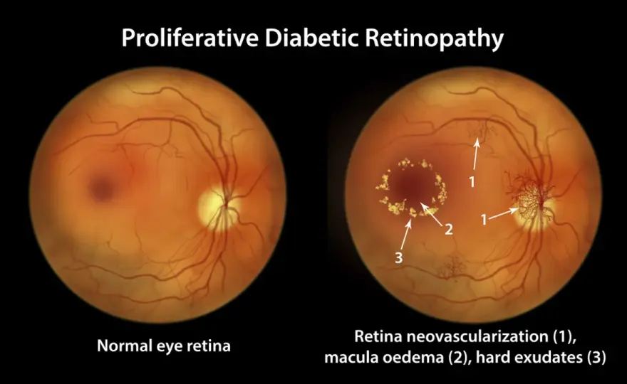 Retinopatia cukrzycowa - leczenie, które ratuje wzrok!
