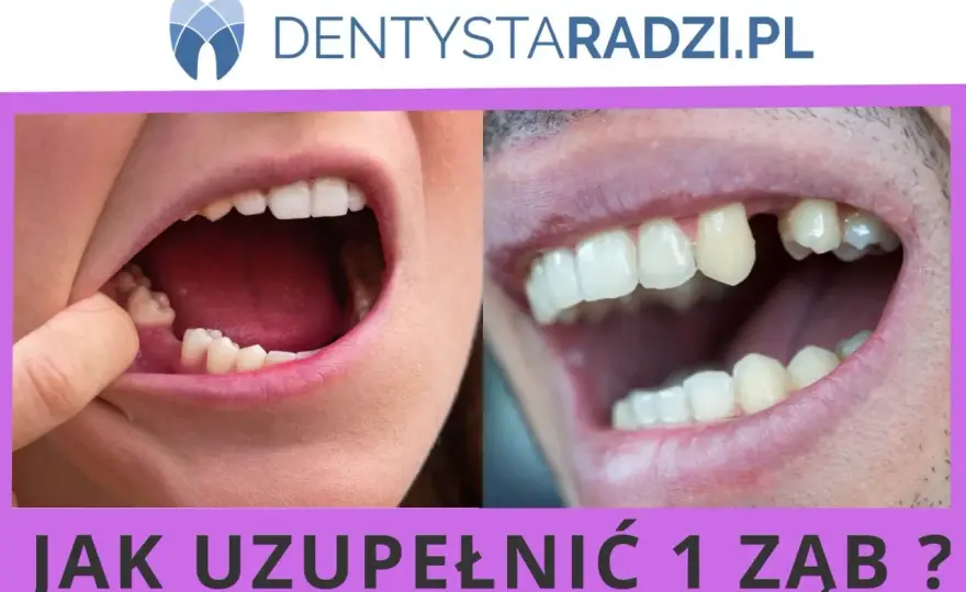 Odbudowa zęba - Kiedy warto, a kiedy to za mało?