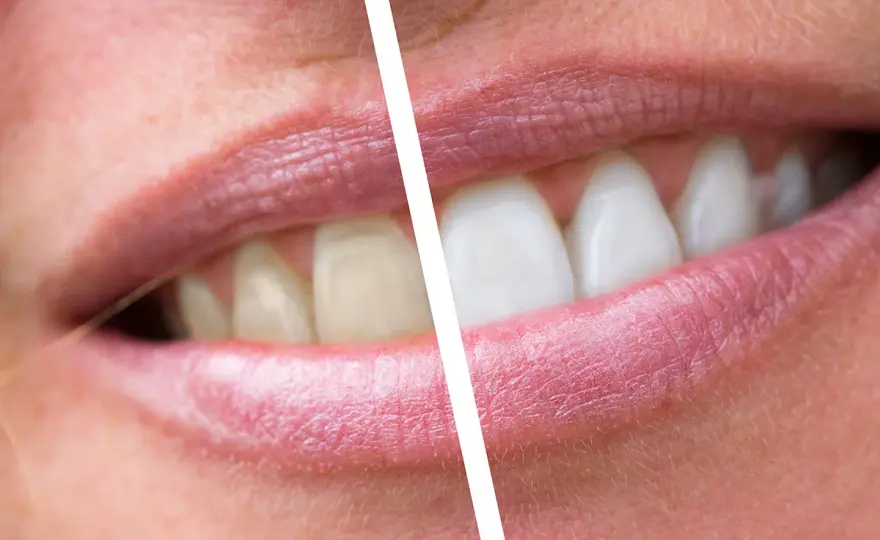 Placca dentale - come riconoscerla e rimuoverla davvero