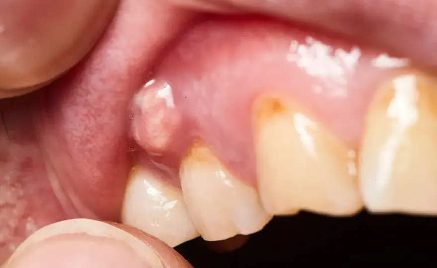 Fistola gengivale su dente incapsulato - cause e cure
