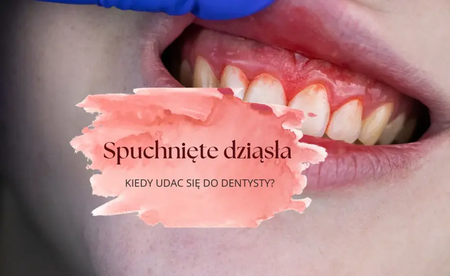 Opuchnięte dziąsło? Natychmiastowa ulga i kiedy do dentysty