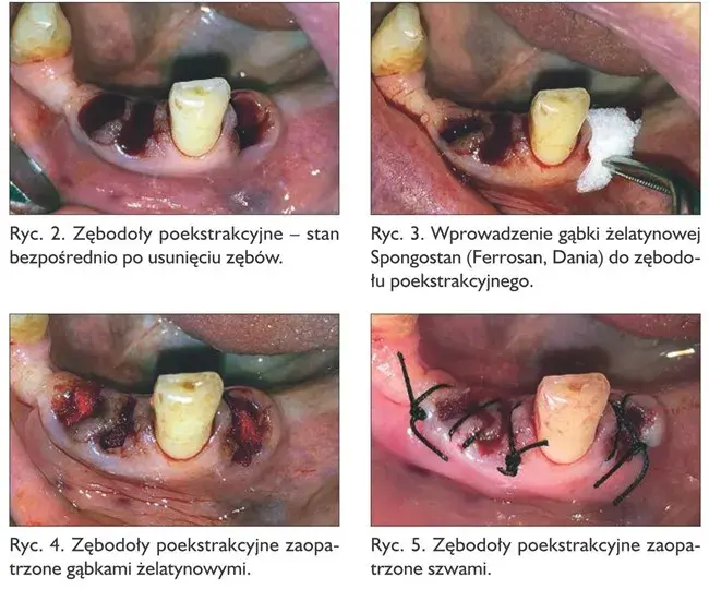 Krwawienie po wyrwaniu zęba: ile trwa i kiedy szukać pomocy?