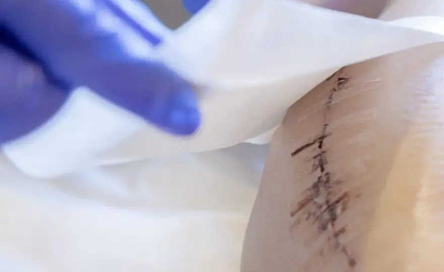 Martwica po lipolizie - jak rozpoznać alarmowe objawy?