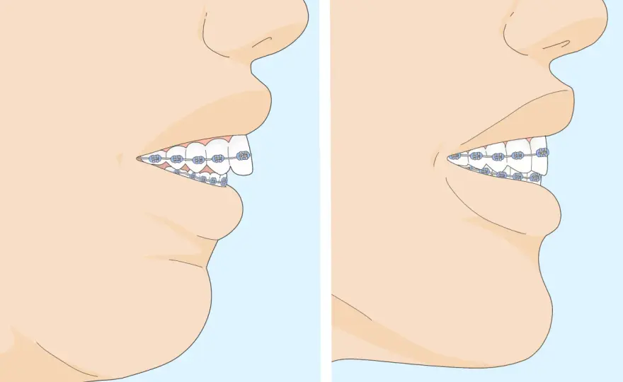 Sobremordida dental, cuándo preocupa y cómo se corrige