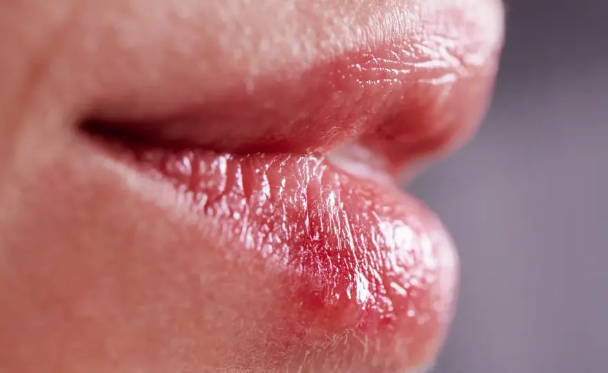 Munsår i mungipan - Herpes eller spricka? Så vet du skillnaden