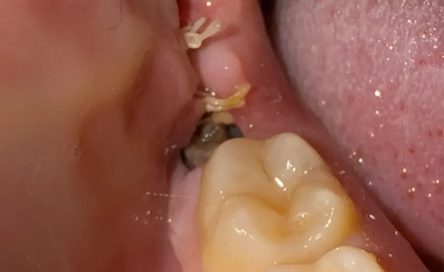 ¿Alveolitis seca tras una muela del juicio? Cómo reconocerla