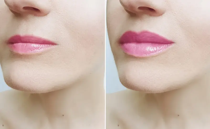 Lip flip - Ile kosztuje i czy warto? Porównanie cen ust