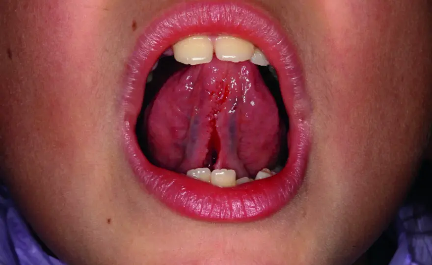 Frenulo linguale nel neonato - quando serve una valutazione?