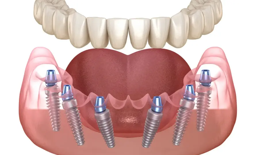 Injerto de hueso dental - complicaciones, cuidados y precios
