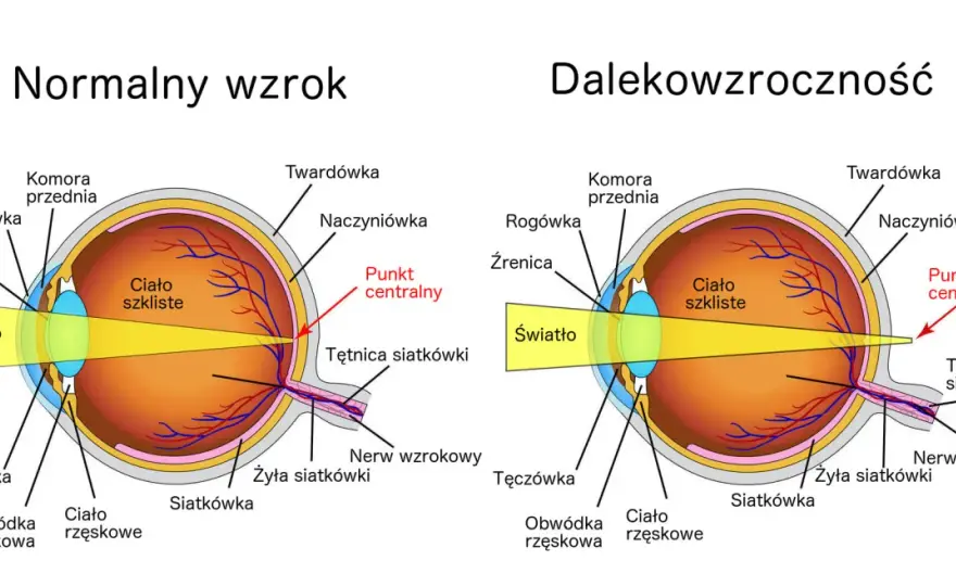 Dalekowzroczność - objawy, korekcja i różnice. Sprawdź!