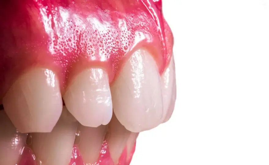Épulis dental en la encía - causas, tipos y tratamiento