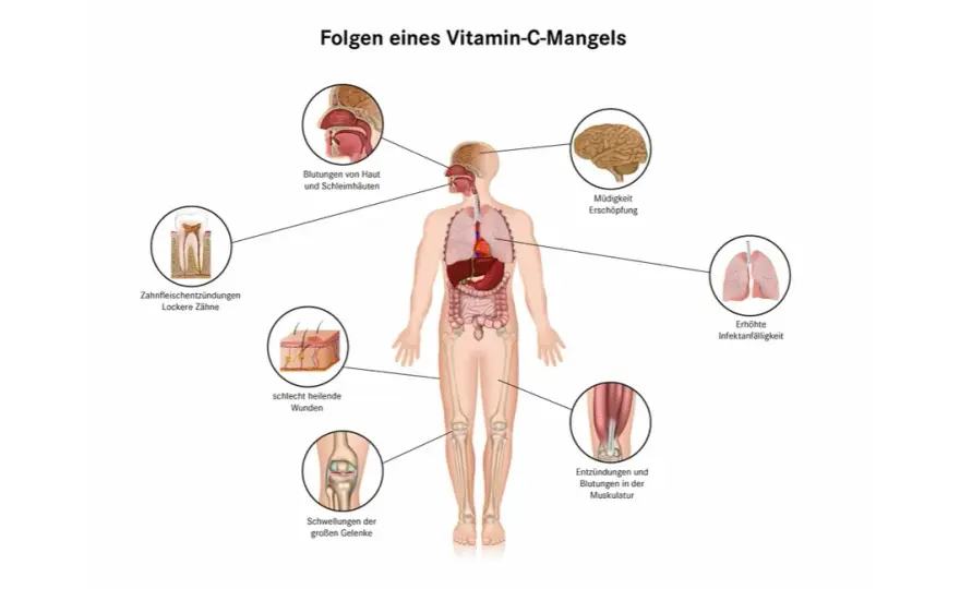 Vitaminmangel Symptome: Erkennen Sie die Warnsignale Ihres Körpers