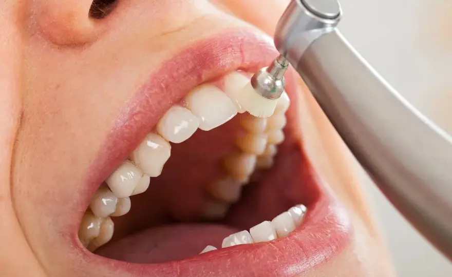 Detartrasi o igiene dentale? Nomi, costi e frequenza ideale