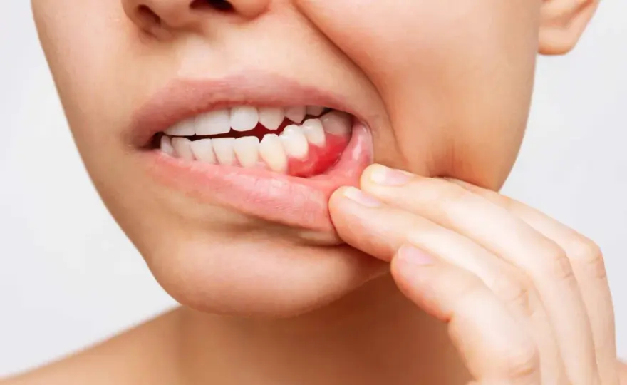 Periodontitis, síntomas y tratamiento para cuidar tus encías