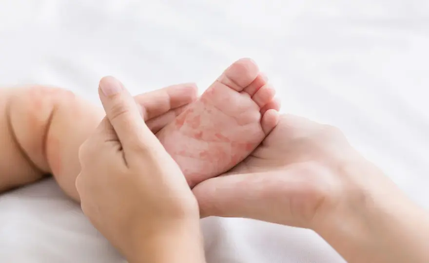 Pieds-mains-bouche chez l’enfant - les bons soins à la maison