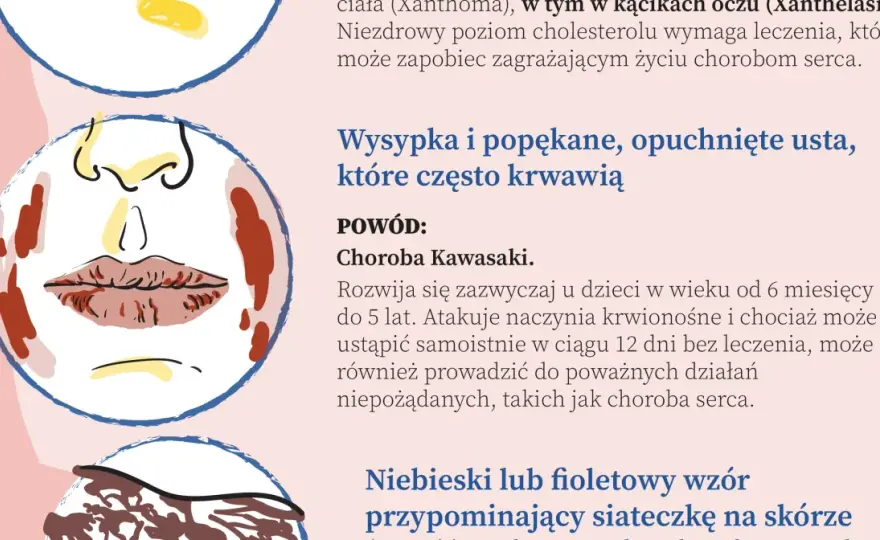 Najczęstsze choroby serca w Polsce - co musisz wiedzieć?