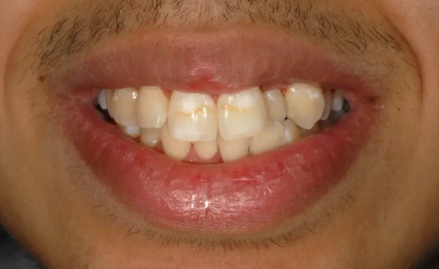 Macchie bianche sui denti - Carie o altro? Scopri cosa fare