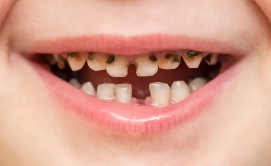 ¿Las caries se contagian? Lo que debes saber sobre la saliva