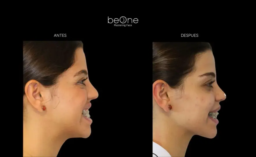 Brackets antes y después en labios y perfil facial