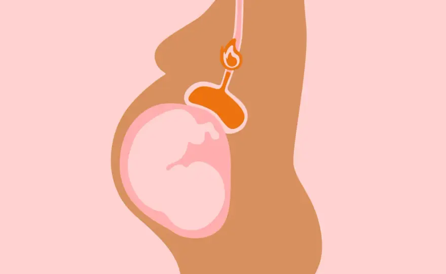 Brûlures d'estomac enceinte - comment les soulager ?