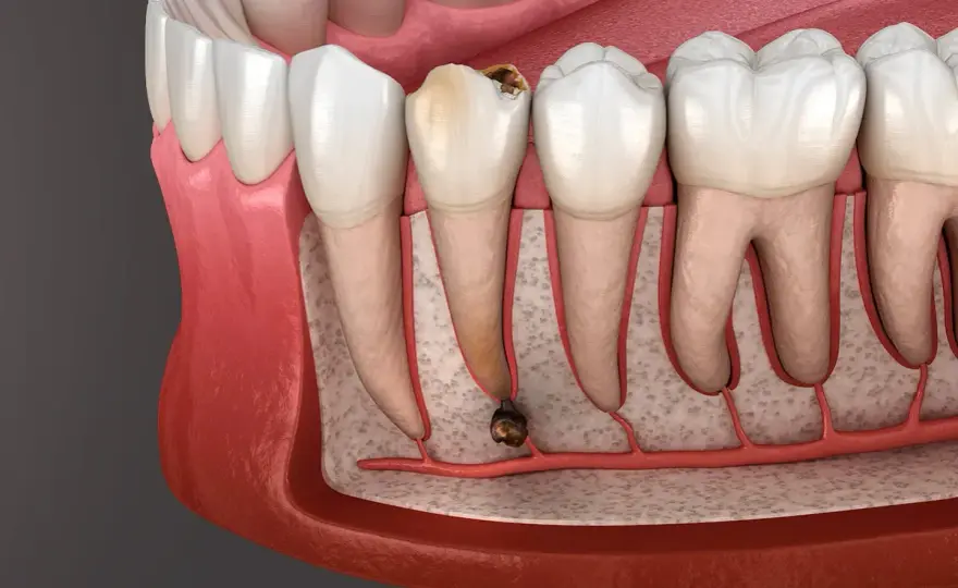¿Se puede extraer una muela infectada? Riesgos y opciones