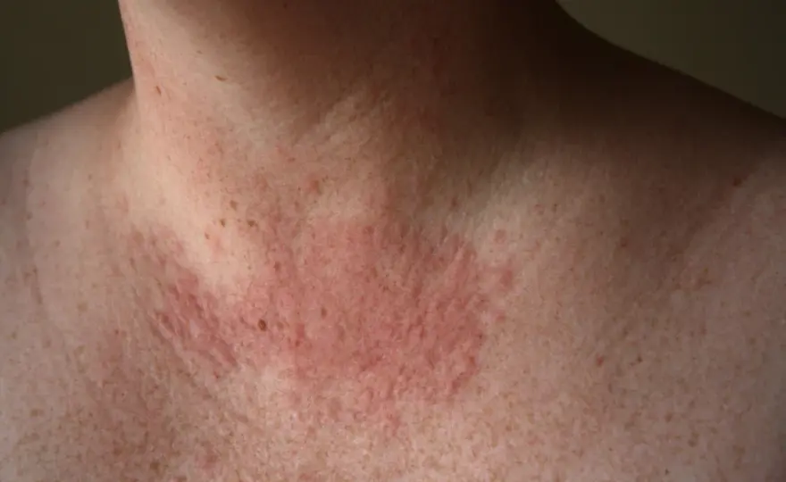 Alergia al sol - ¿Qué es y cómo proteger tu piel?
