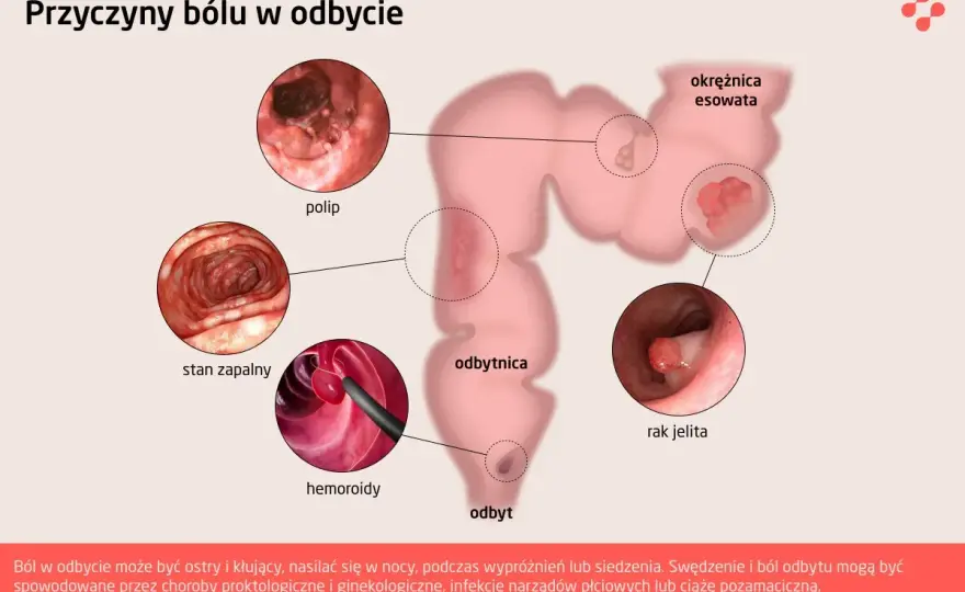 Ból odbytu - Przyczyny, objawy, leczenie. Kiedy do lekarza?
