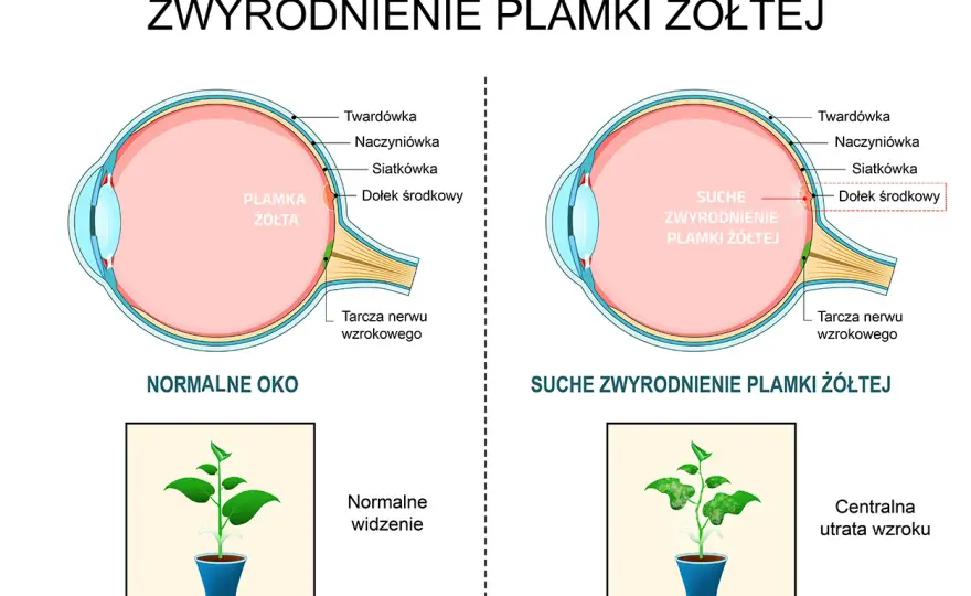 Zwyrodnienie plamki żółtej (AMD) - Objawy, leczenie, profilaktyka